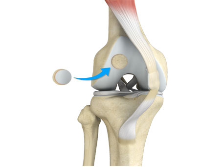 Minimally Invasive Joint-Preserving Surgery for Athletes